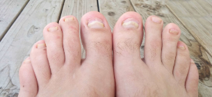 Fungus of the toenails
