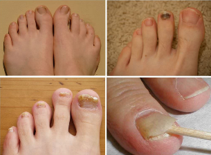 Signs of nail fungus
