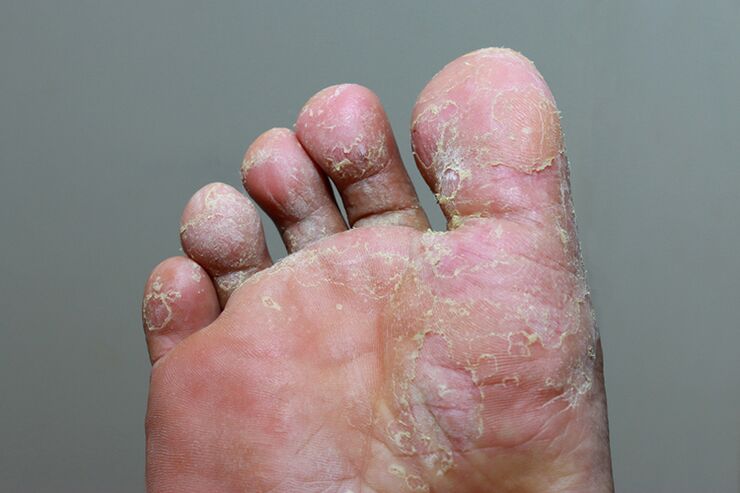 severe stage of mycosis of the skin of the toes