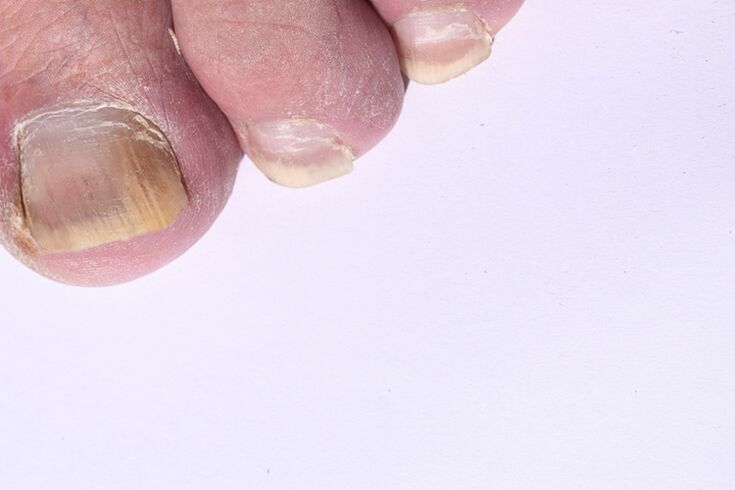 the initial stage of mycosis of toenails