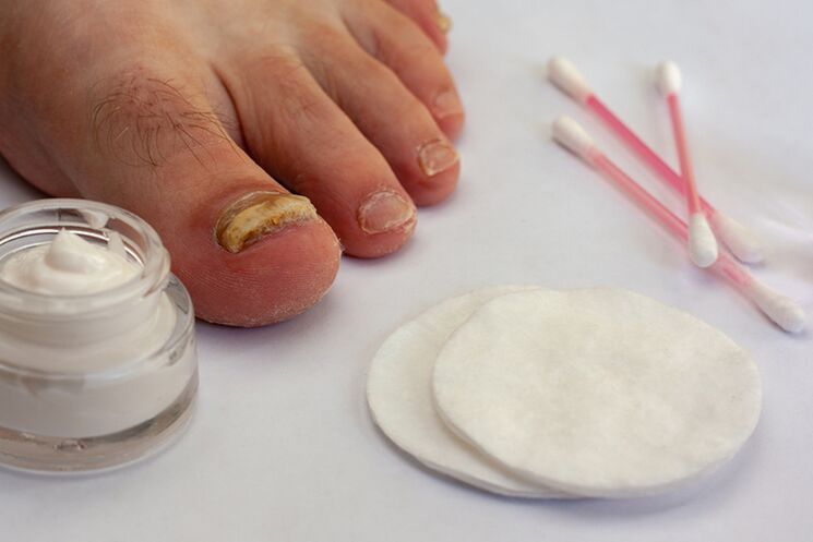 toe fungus treatment with fungus cream