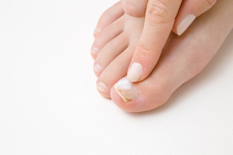 treatment of toes with ointment for fungus