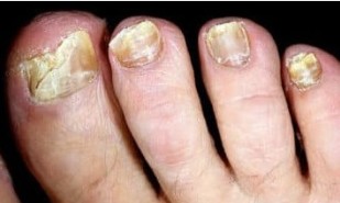 The risk of onychomycosis