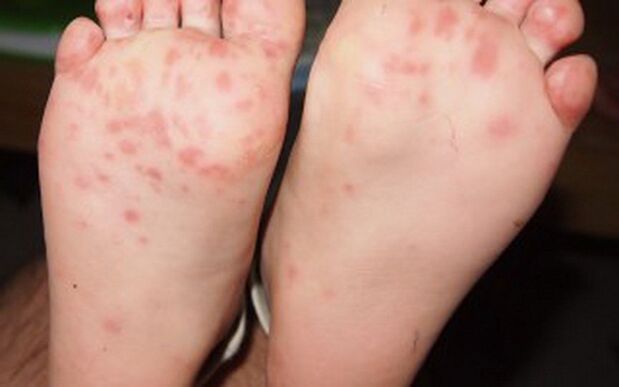 Vesicular form of fungus on the legs