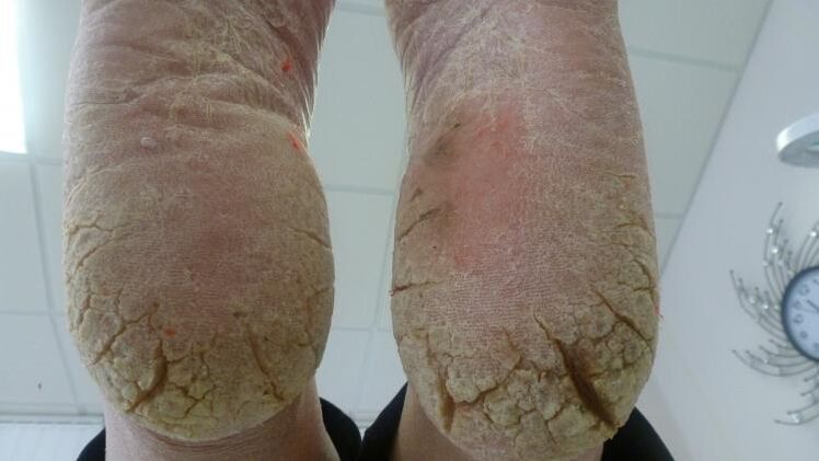 manifestations of fungus on the feet