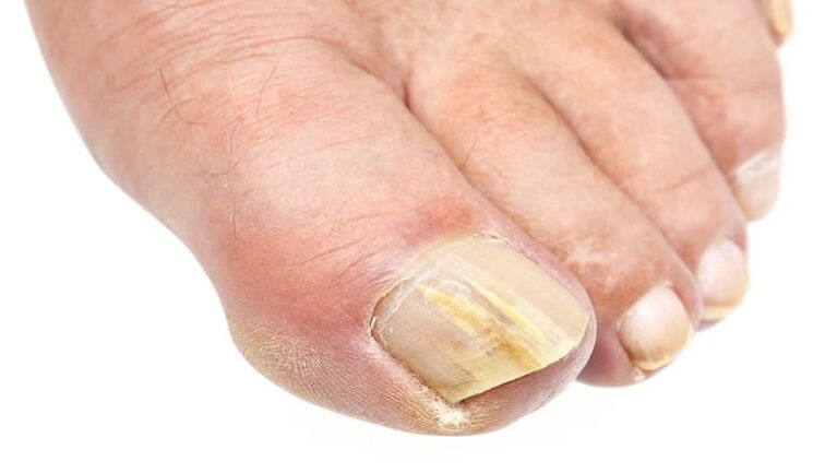 external change in the nail is a sign of fungal infection