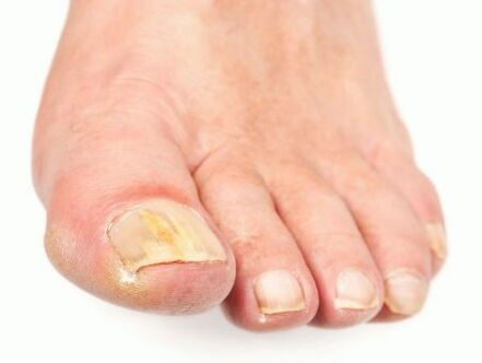 damage to the nails with fungus on the feet