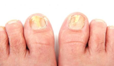 manifestations of toenail fungus