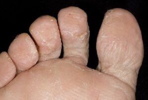 symptoms of fungus on the skin of the feet
