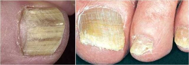 Advanced form of toenail fungus