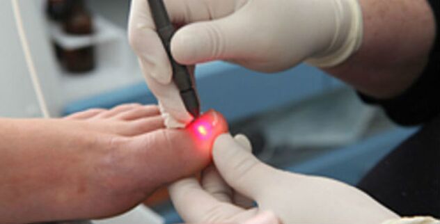 Laser therapy for toenail fungus