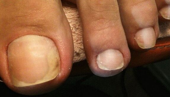 Signs of the initial stage of toenail fungus