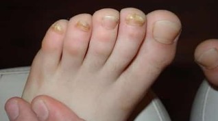 Fungus affected almost all toes
